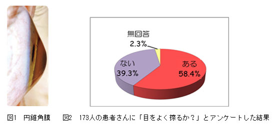 円錐角膜