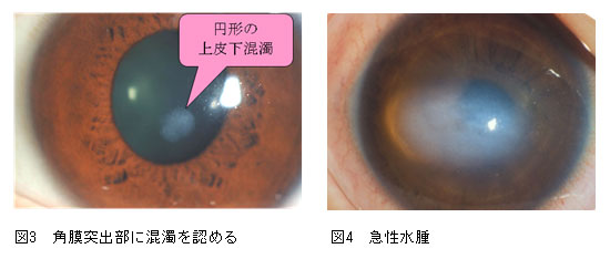 円錐角膜の症状