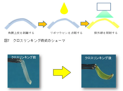 角膜クロスリンキング